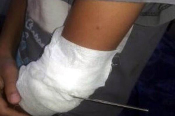 Haylaz çocuk, kolunda tığla hastaneye getirildi