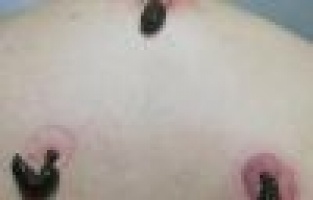 Sülük Tedavisi Alternatif Tıp Değil